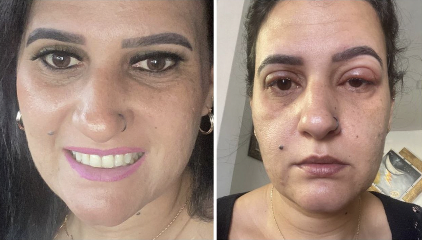 Termina hospitalizada mujer brasileña por pestañas postizas