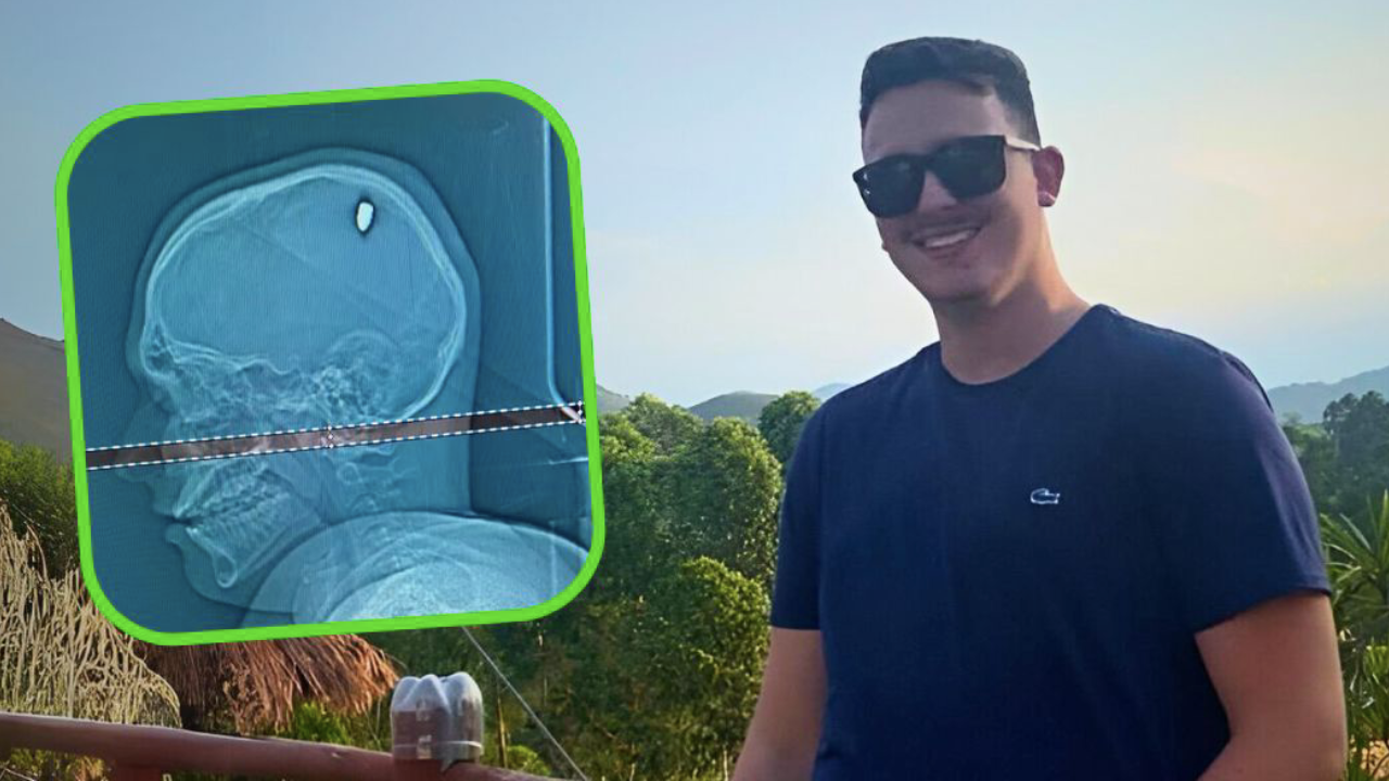 mateus facio joven brasileño pasa cuatro días de fiesta con bala en la cabeza