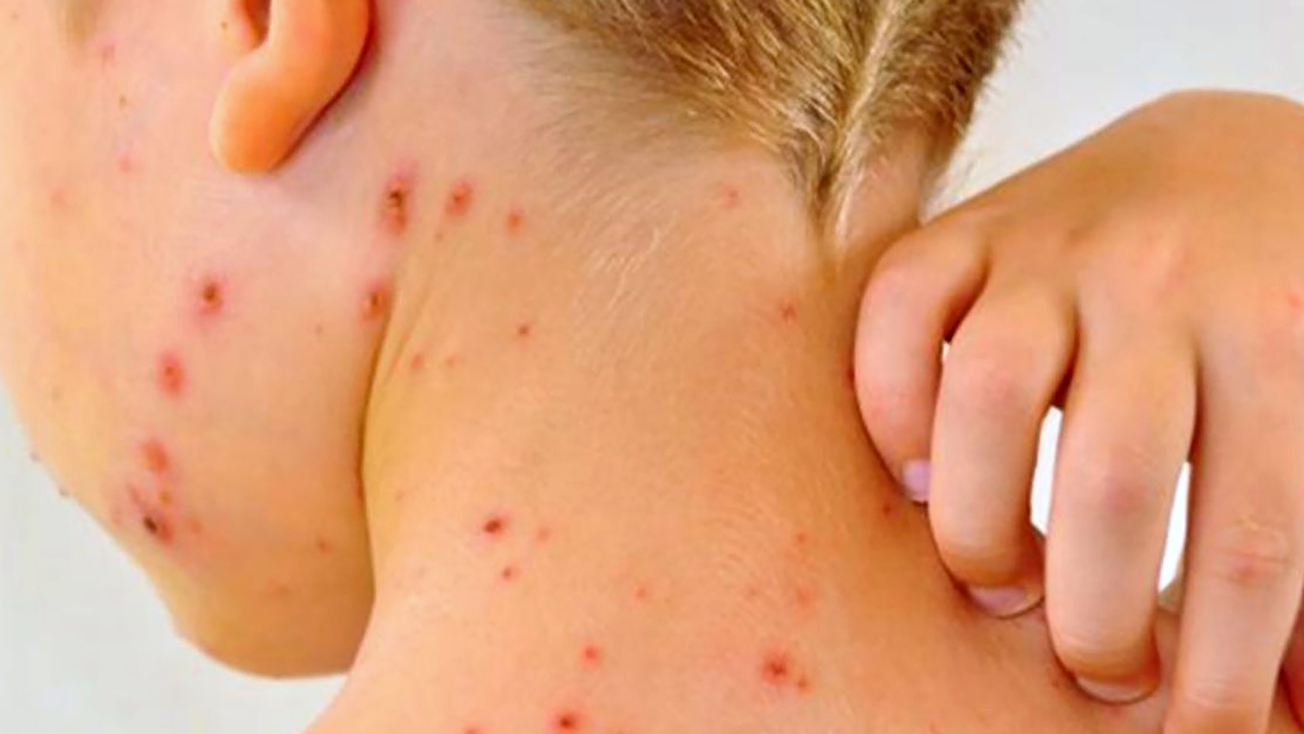 Aumentan casos de sarampión en México, suman 4 fallecidos