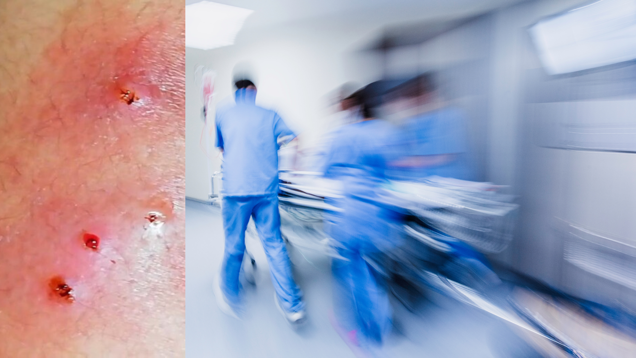 Suman en México 13 casos de infección por gusano barrenador, ¿cómo se contagia?