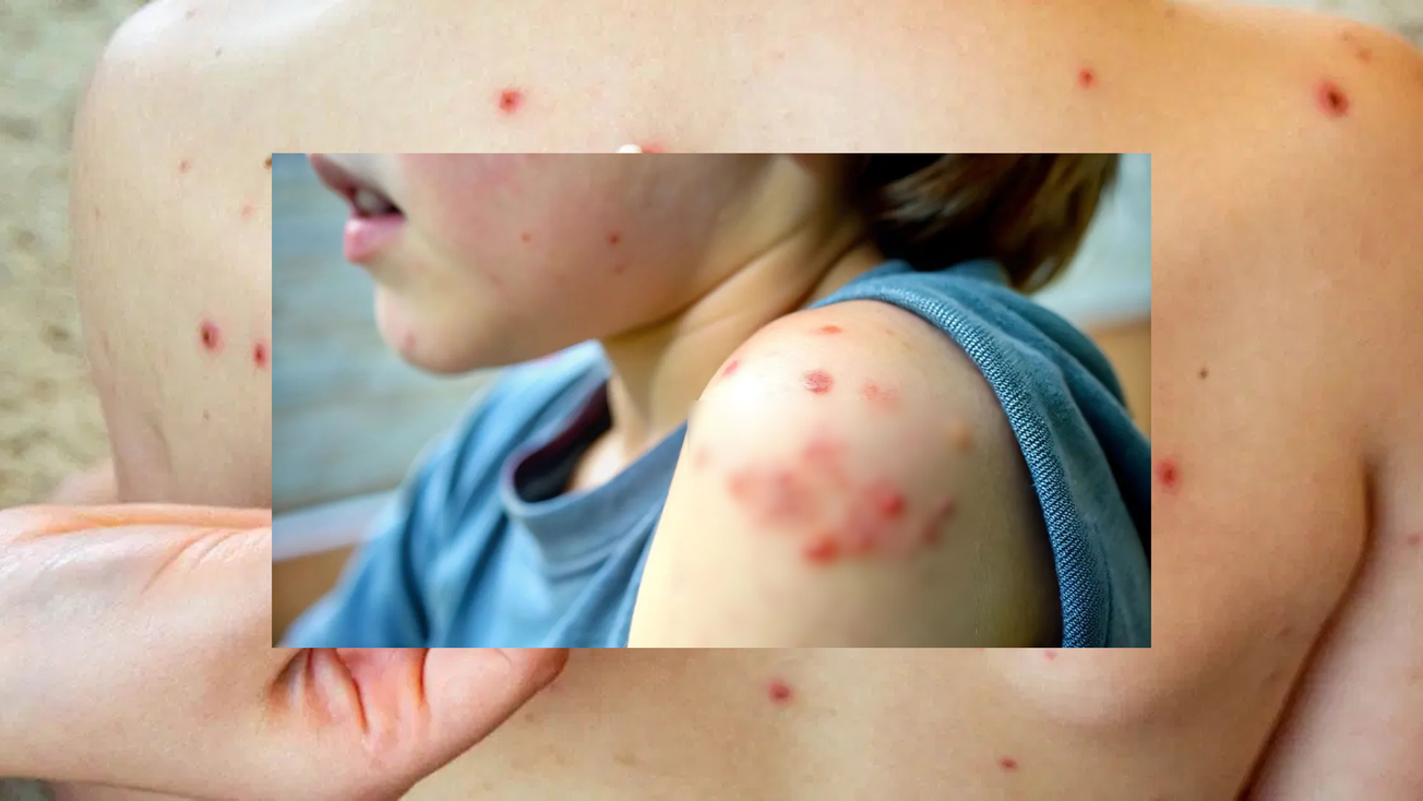 Aumentan dramáticamente casos de sarampión en México: hay decesos