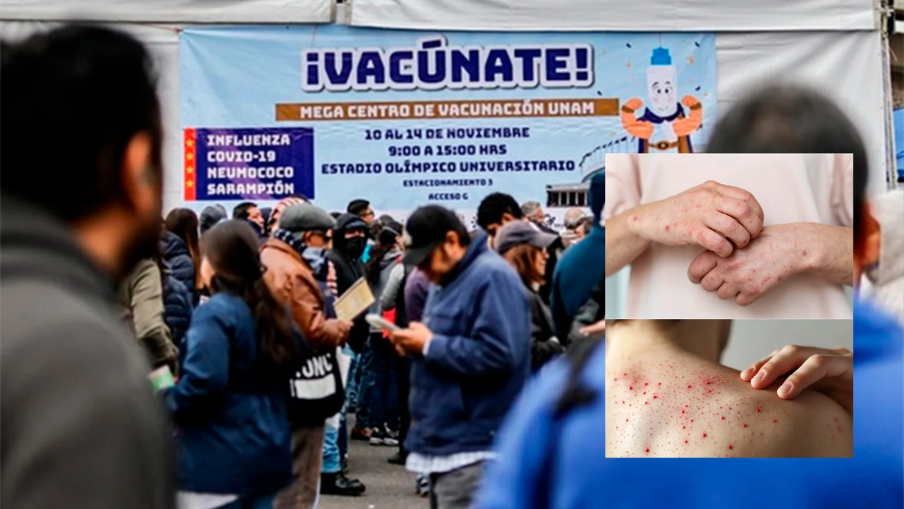 México debe controlar sarampión en 60 días para evitar crisis